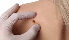 13 травня – Всесвітній День МЕЛАНОМИ