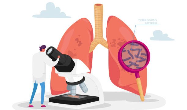 Що потрібно знати про туберкульоз